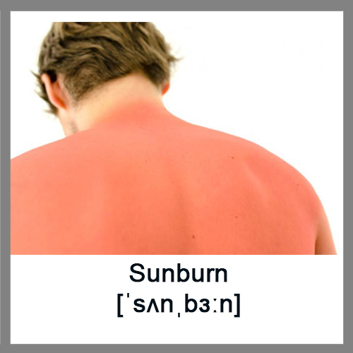 Sunburn